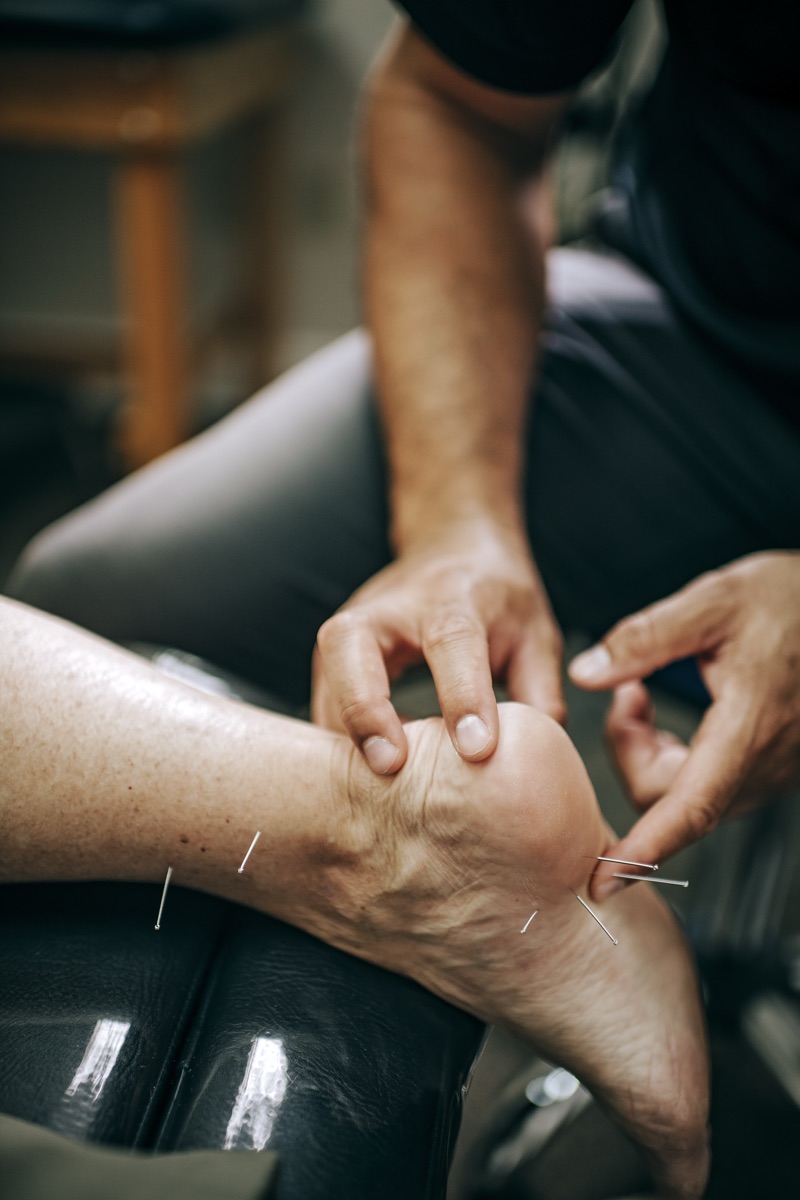 Dry Needling